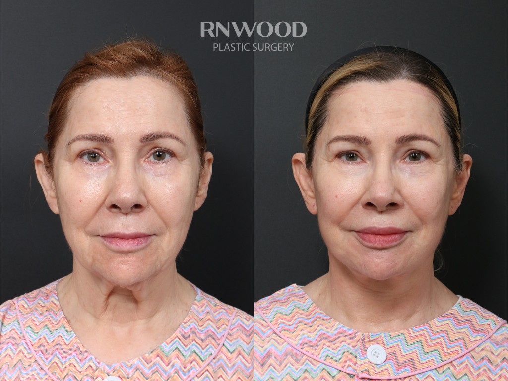 DEEP PLANE FACELIFT and Necklift, before and after, front view, case 01