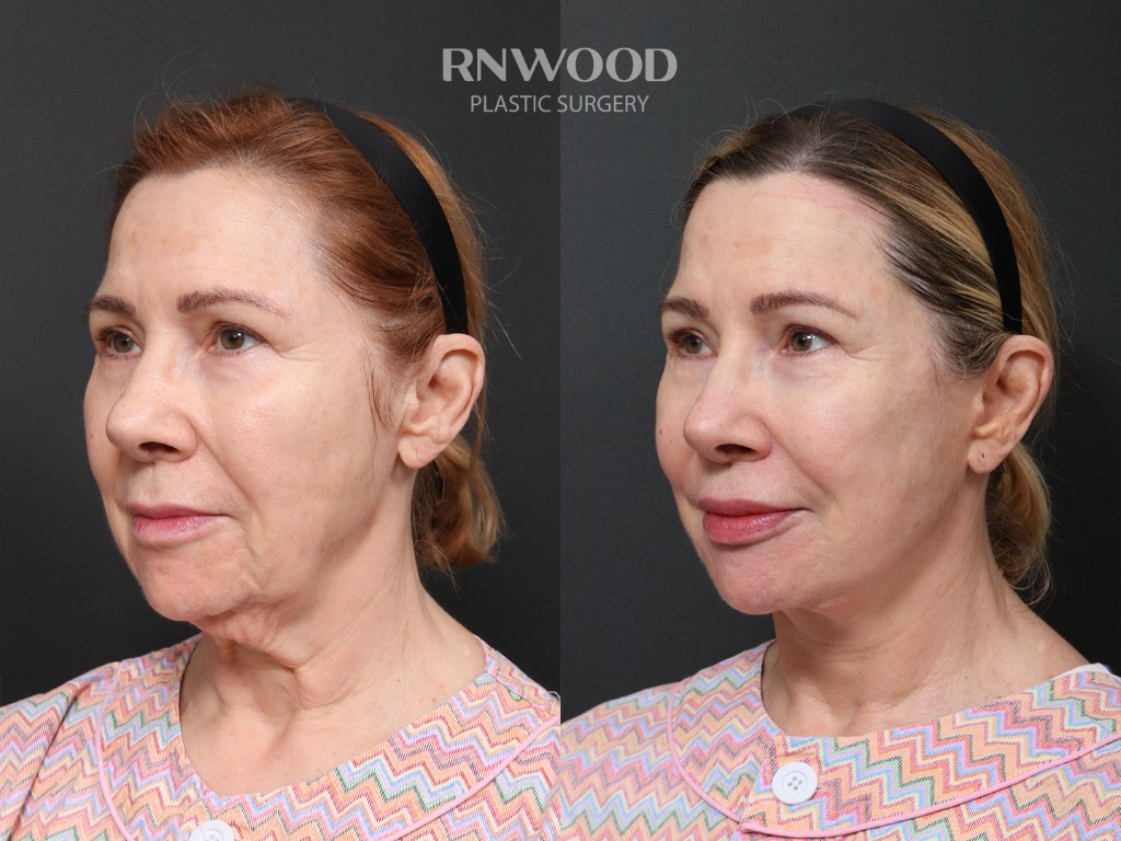 DEEP PLANE FACELIFT and Necklift, before and after, left three-quarter view, case 01