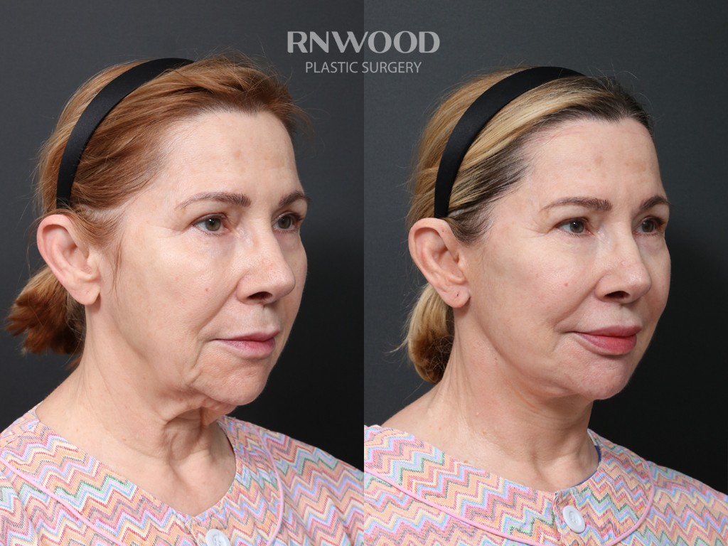 DEEP PLANE FACELIFT and Necklift, before and after, right three-quarter view, case 01