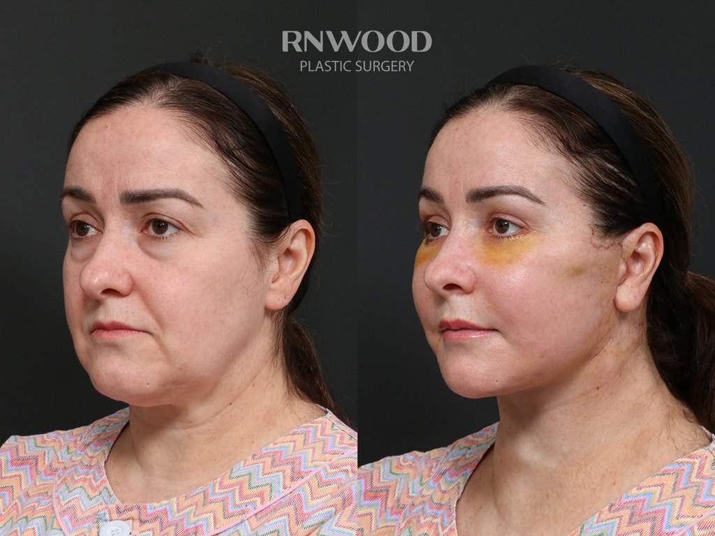 DEEP PLANE FACELIFT and Necklift, before and after, left three-quarter view, case 02