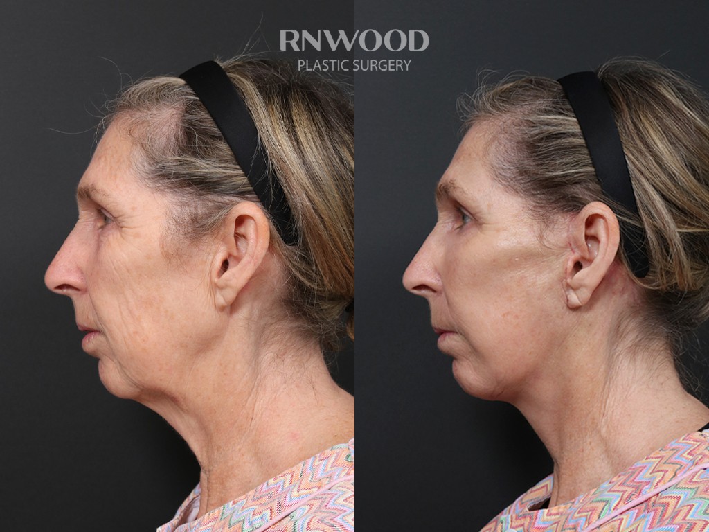 DEEP PLANE FACELIFT and Necklift, before and after, left profile view, case 03