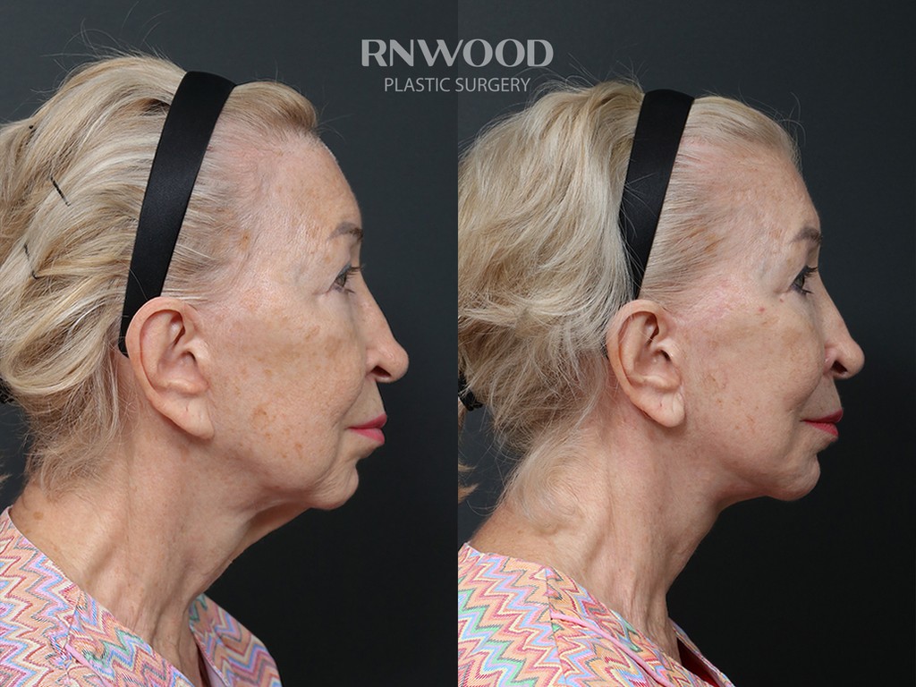 Revision DEEP PLANE FACELIFT and Necklift, before and after, right profile view, case 04