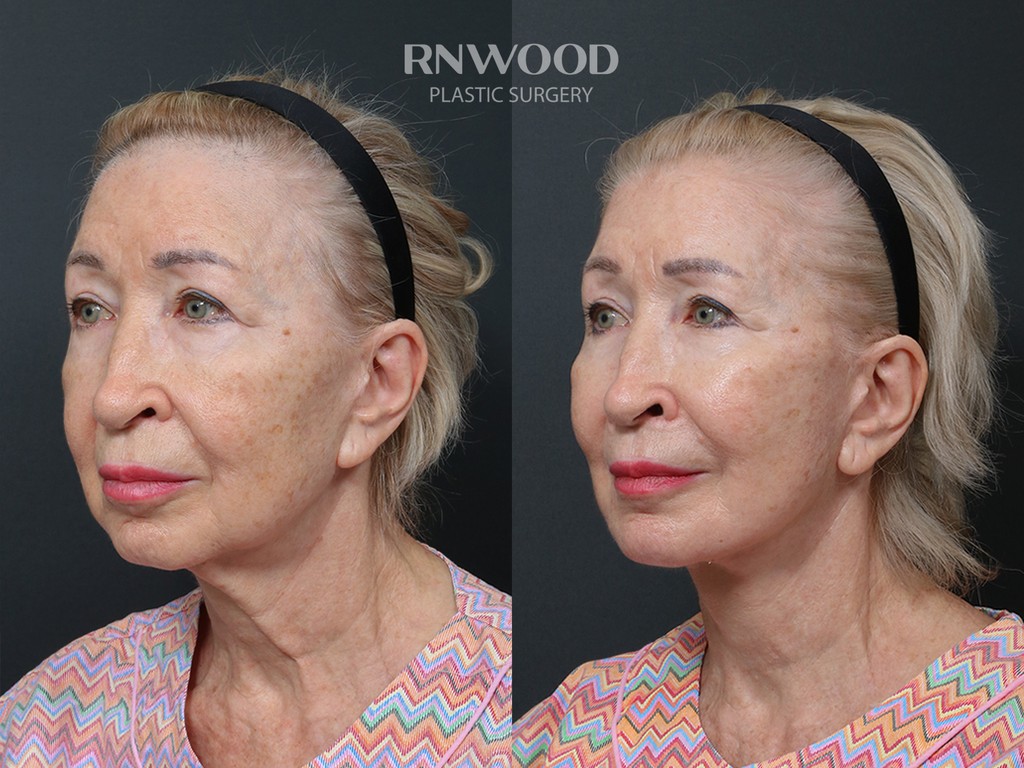 Revision DEEP PLANE FACELIFT and Necklift, before and after, left three-quarter view, case 04