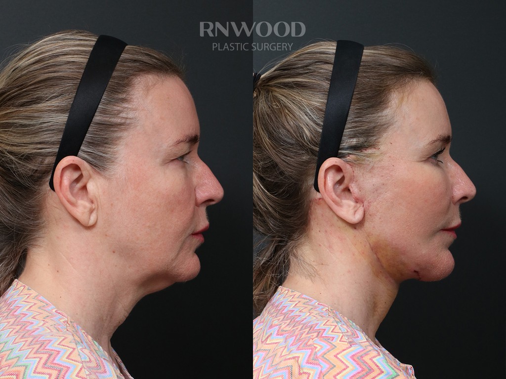 DEEP PLANE FACELIFT and Necklift, before and after, right profile view, case 05