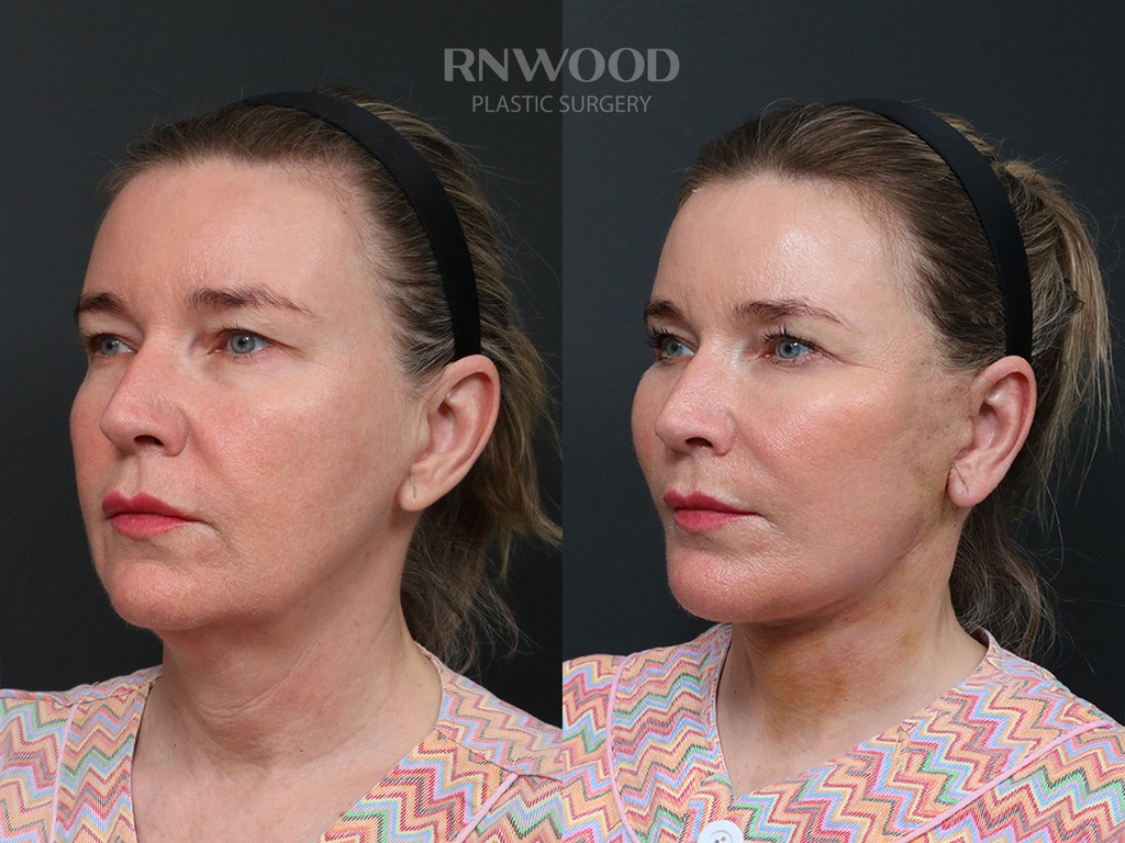 DEEP PLANE FACELIFT and Necklift, before and after, left three-quarter view, case 05
