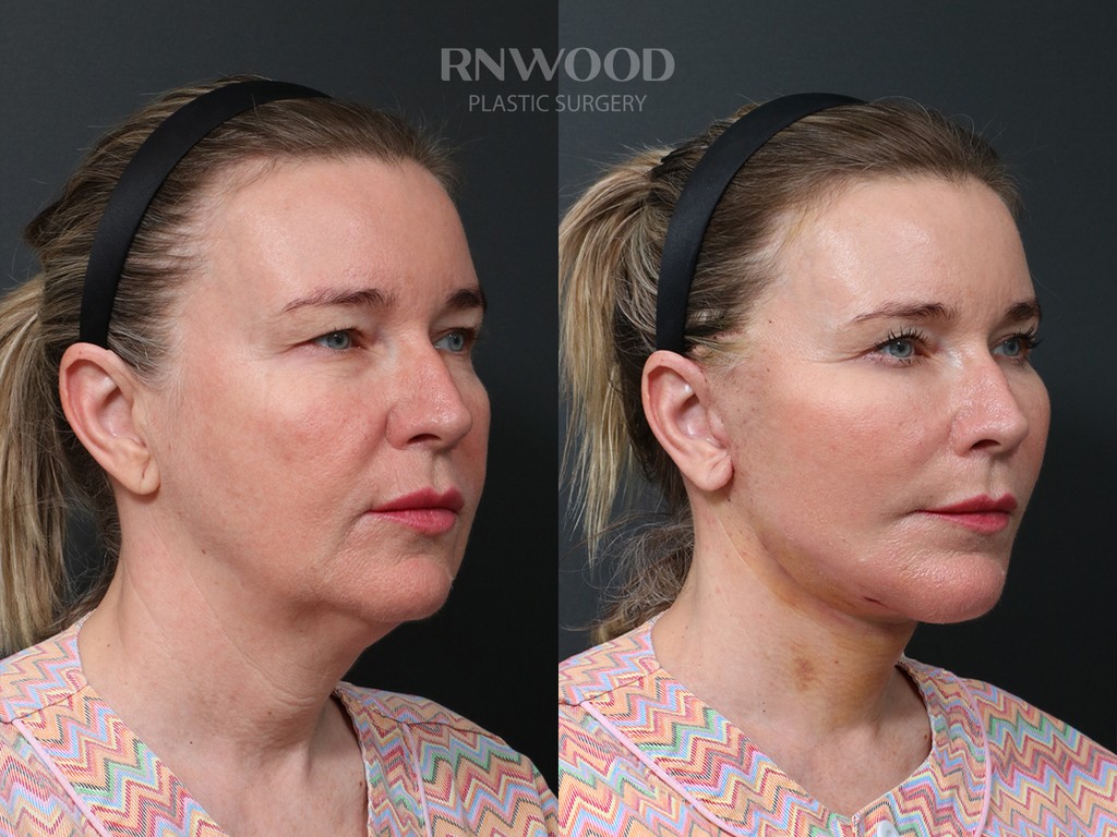 DEEP PLANE FACELIFT and Necklift, before and after, right three-quarter view, case 05