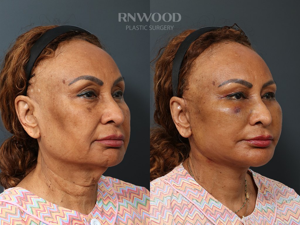 DEEP PLANE FACELIFT and Necklift, before and after, right three-quarter view, case 06