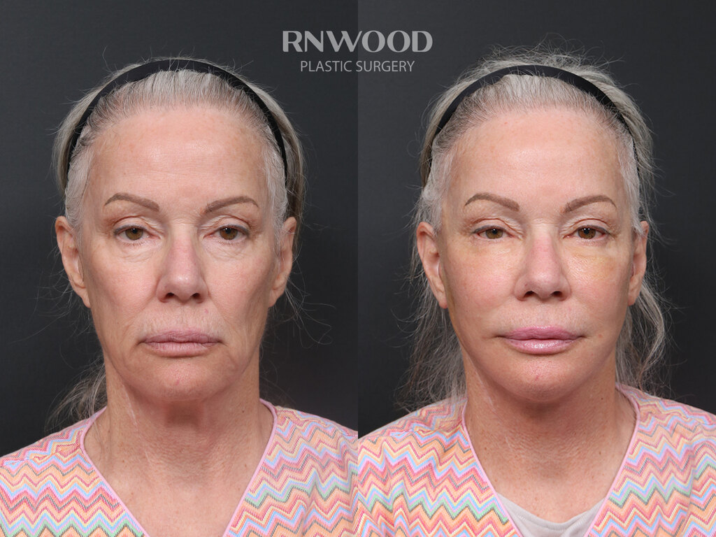 Revision DEEP PLANE FACELIFT and Necklift, before and after, front view, case 07