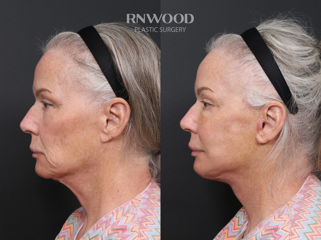 Revision DEEP PLANE FACELIFT and Necklift, before and after, left profile view, case 07