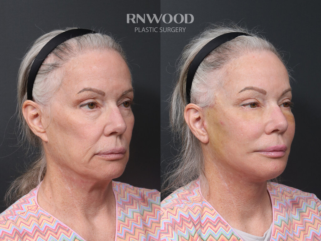Revision DEEP PLANE FACELIFT and Necklift, before and after, right three-quarter view, case 07