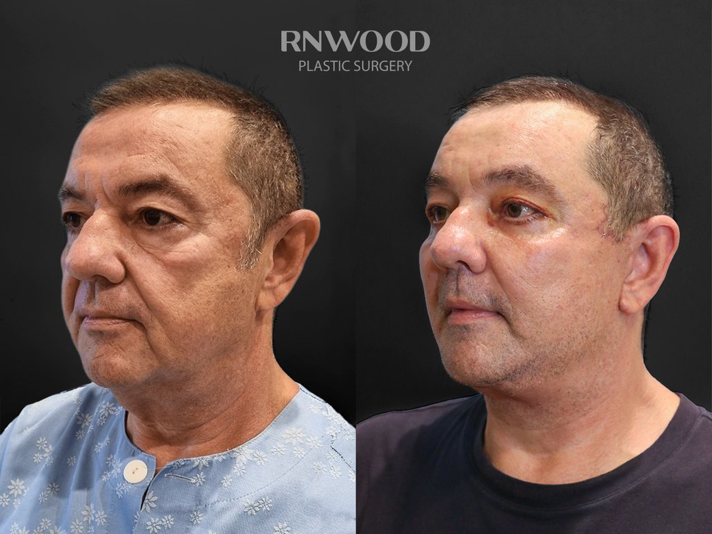 DEEP PLANE FACELIFT and Necklift, before and after, left three-quarter view, case 08