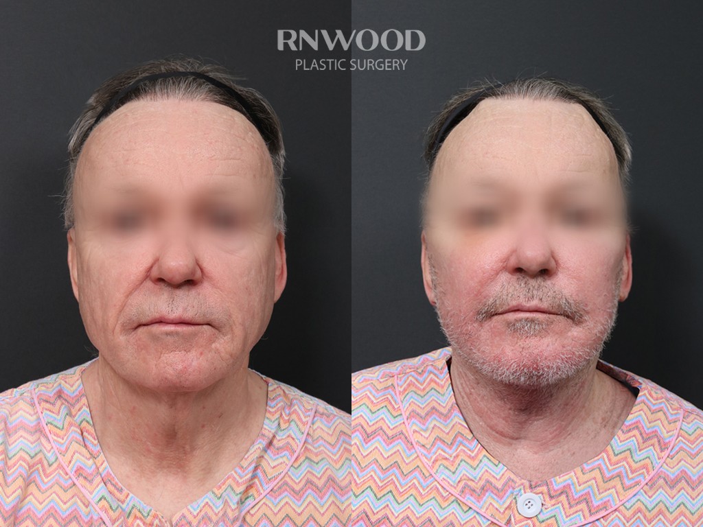 DEEP PLANE FACELIFT and Necklift, before and after, front view, case 09
