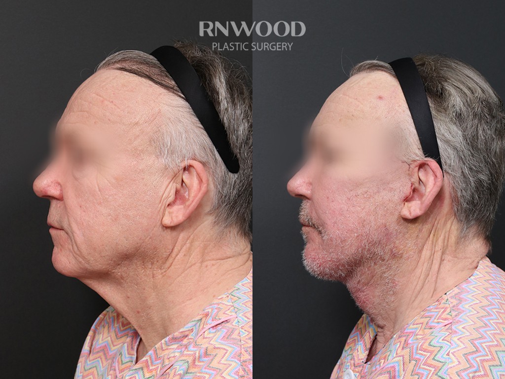 DEEP PLANE FACELIFT and Necklift, before and after, left profile view, case 09