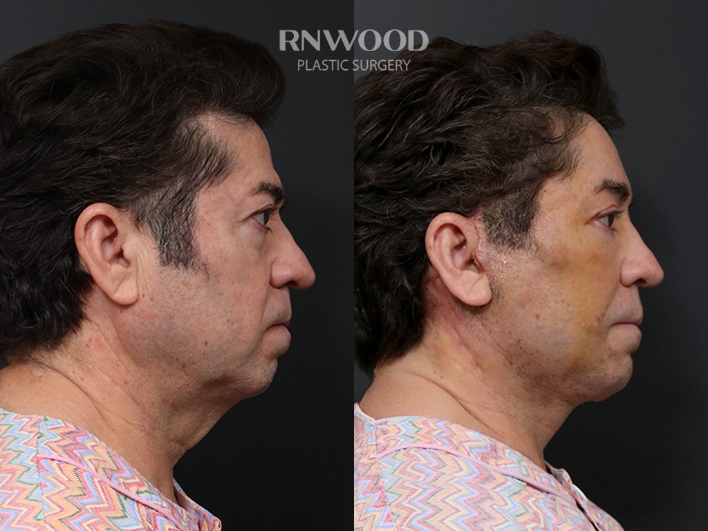 DEEP PLANE FACELIFT and Necklift, before and after, right profile view, case 10