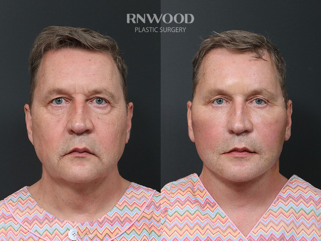 DEEP PLANE FACELIFT and Necklift, before and after, front view, case 11
