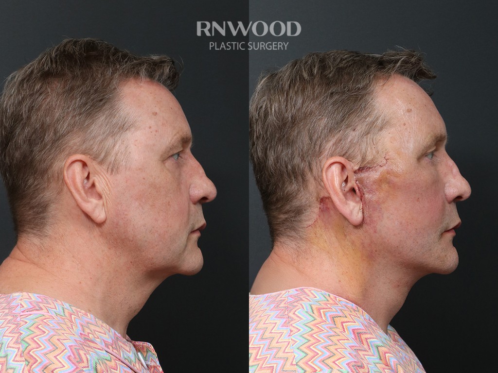 DEEP PLANE FACELIFT and Necklift, before and after, right profile view, case 11