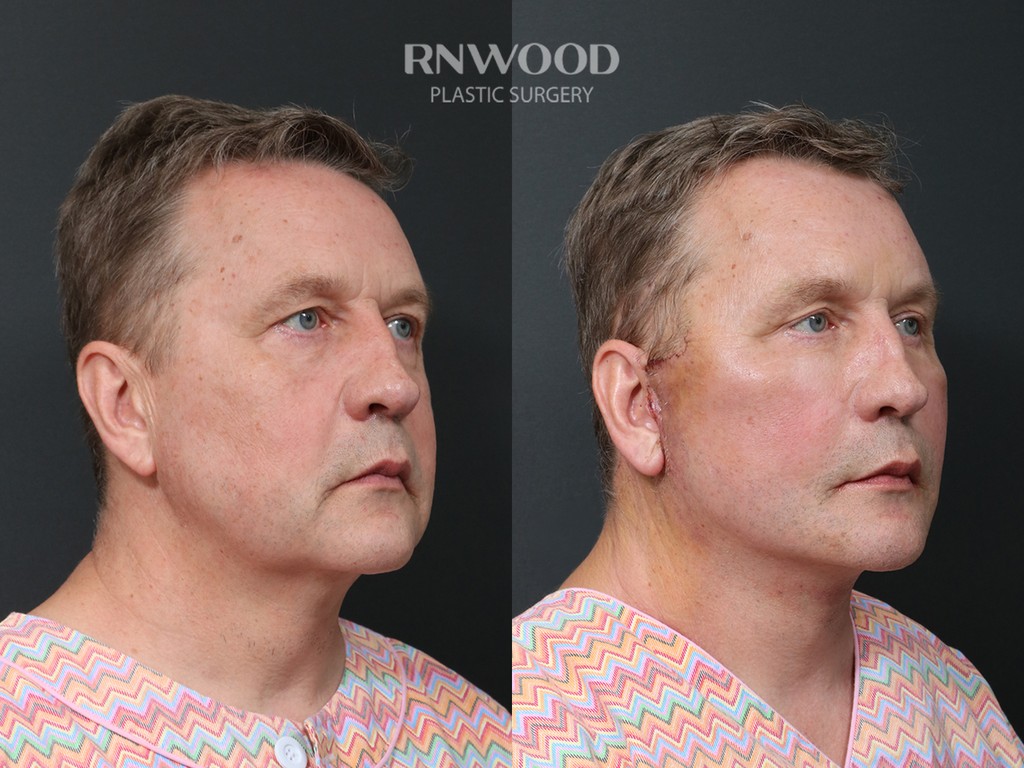 DEEP PLANE FACELIFT and Necklift, before and after, right three-quarter view, case 11