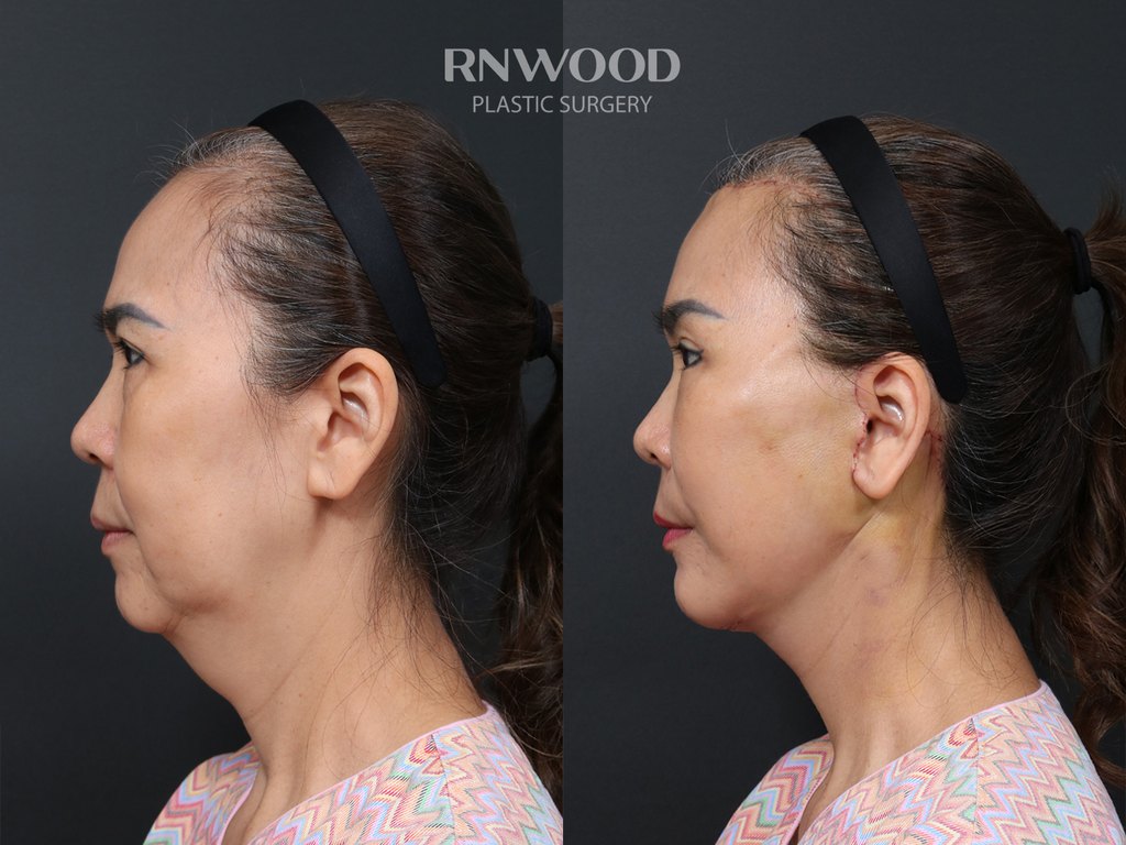DEEP PLANE FACELIFT and Necklift, before and after, left profile view, case 12