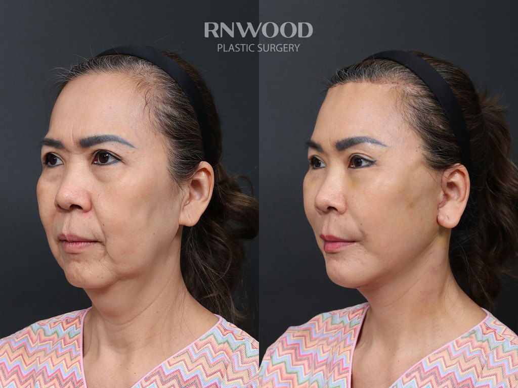 DEEP PLANE FACELIFT and Necklift, before and after, left three-quarter view, case 12