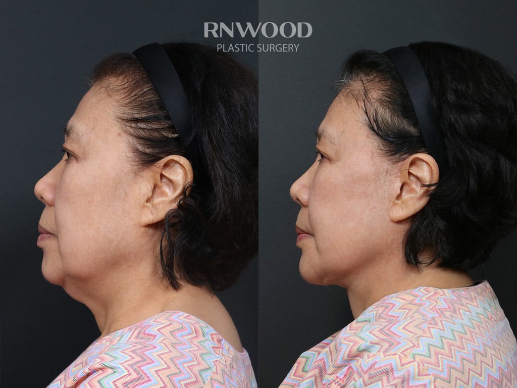 DEEP PLANE FACELIFT and Necklift, before and after, left profile view, case 13