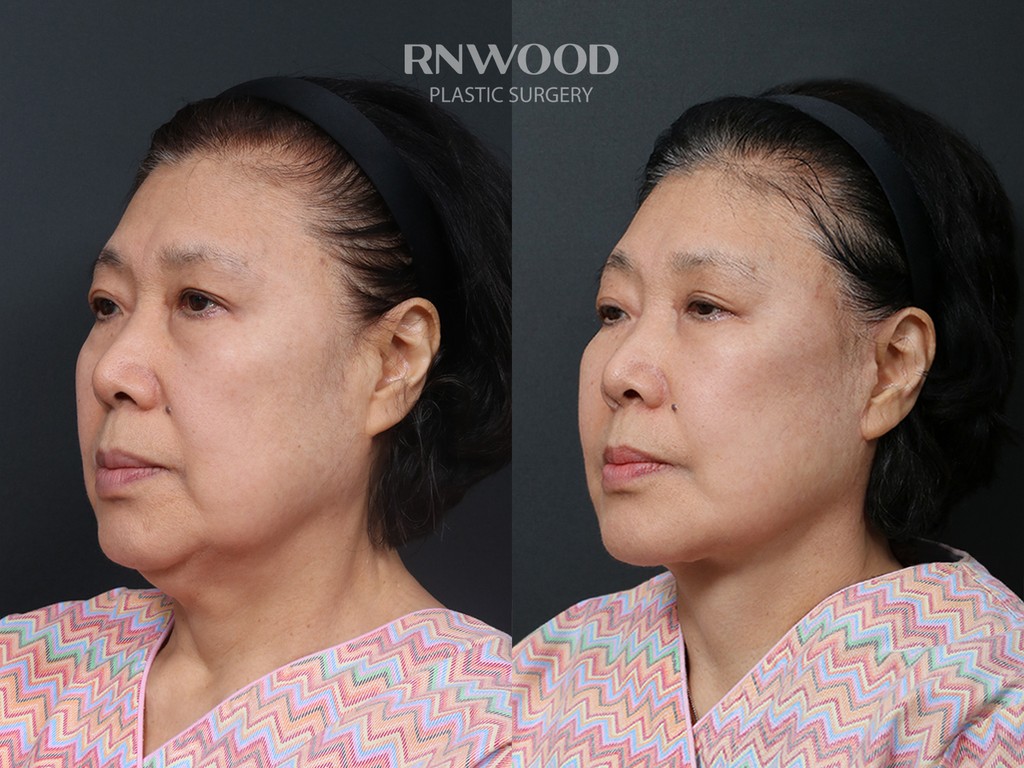 DEEP PLANE FACELIFT and Necklift, before and after, left three-quarter view, case 13