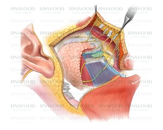 Photograph 2 accompanying the article “Inclusion of Orbicularis Oculi Muscle in SMAS Flap in Asian Facelifts”.