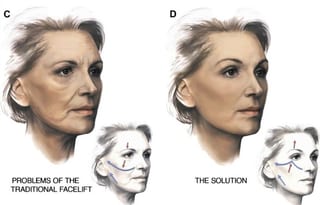 Original image from “Current Trends and Perspectives on Facelifts”.