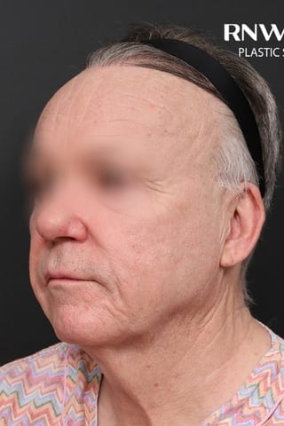 Before view, left oblique — Deep Plane Facelift.