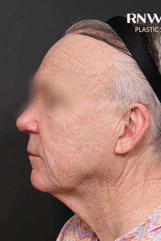 Before view, left profile — Deep Plane Facelift.