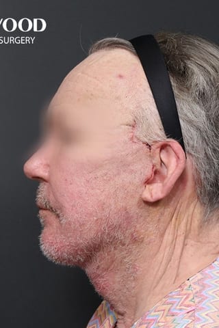 After view, left profile — Deep Plane Facelift.