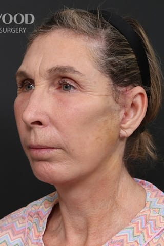 After view, left oblique — Deep Plane Facelift + Mid-Face.