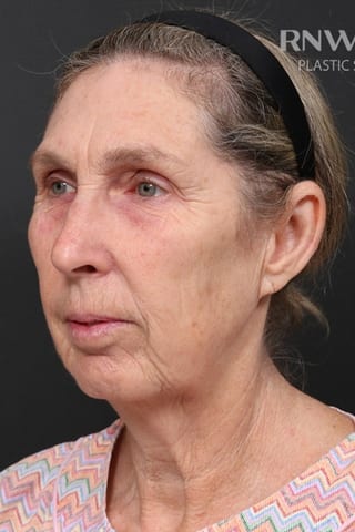 Before view, left oblique — Deep Plane Facelift + Mid-Face.
