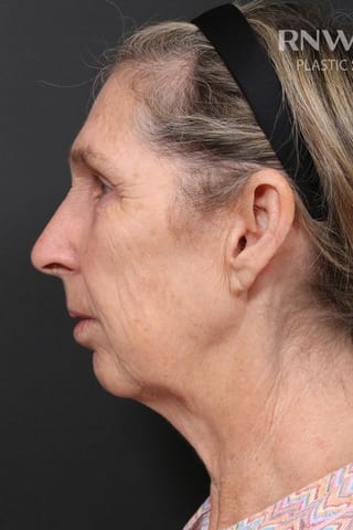 Before view, left profile — Deep Plane Facelift + Mid-Face.