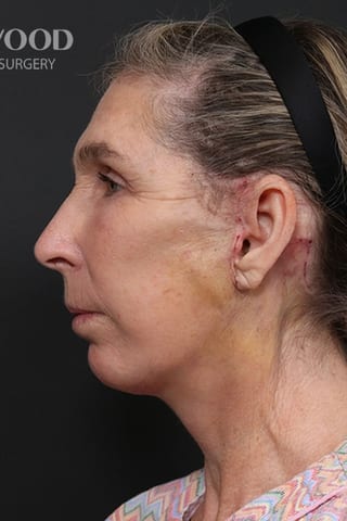 After view, left profile — Deep Plane Facelift + Mid-Face.
