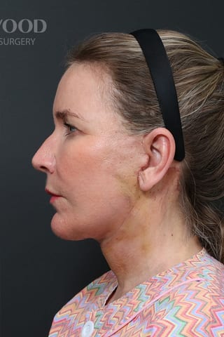 After view, left profile — Before and after · 01.