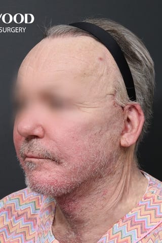After view, left oblique — Deep Plane Facelift.