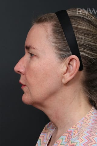 Before view, left profile — Before and after · 01.